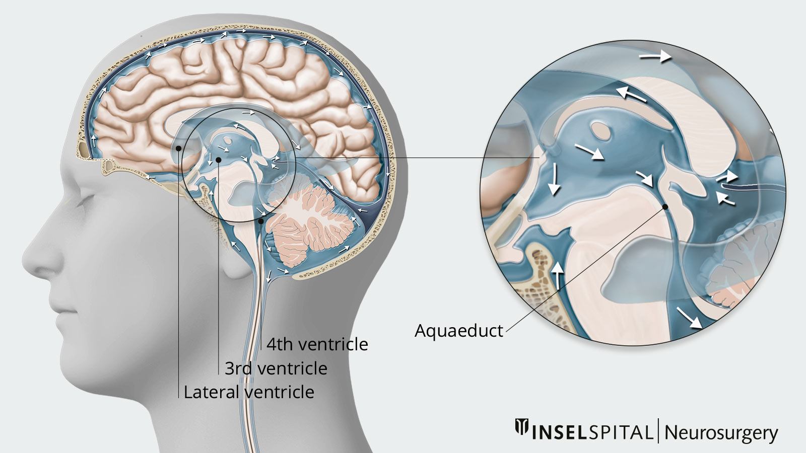 Drawing of the cerebral ventricles and the aqueduct between the 3rd and 4th cerebral ventricles