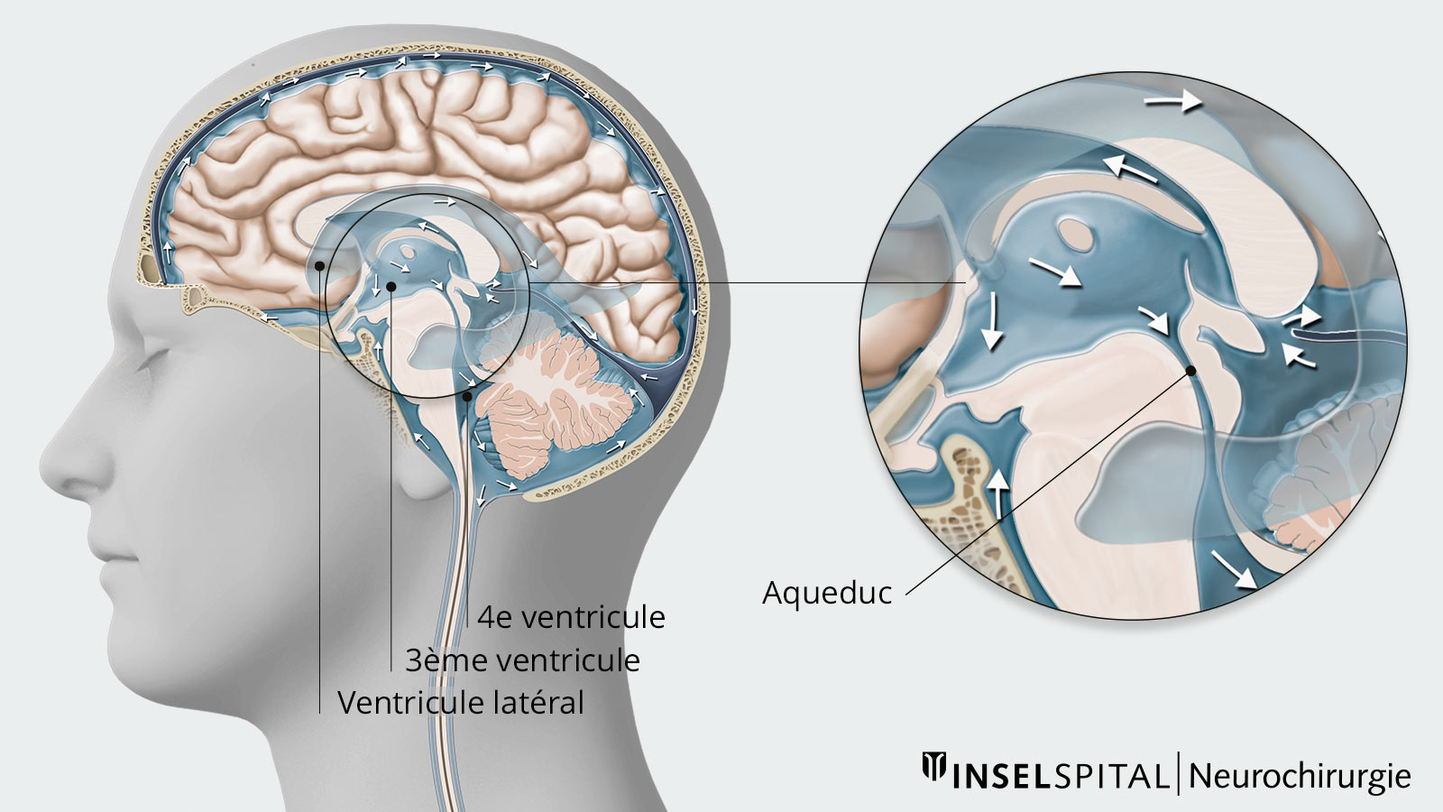 Dessin des ventricules cérébraux et de l'aqueduc entre les 3ème et 4ème ventricules cérébraux