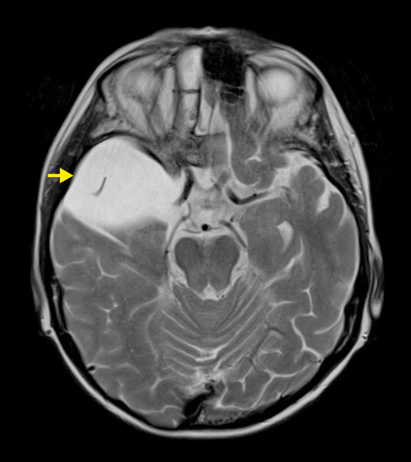 Skull MRI with clearly visible arachnoid cyst