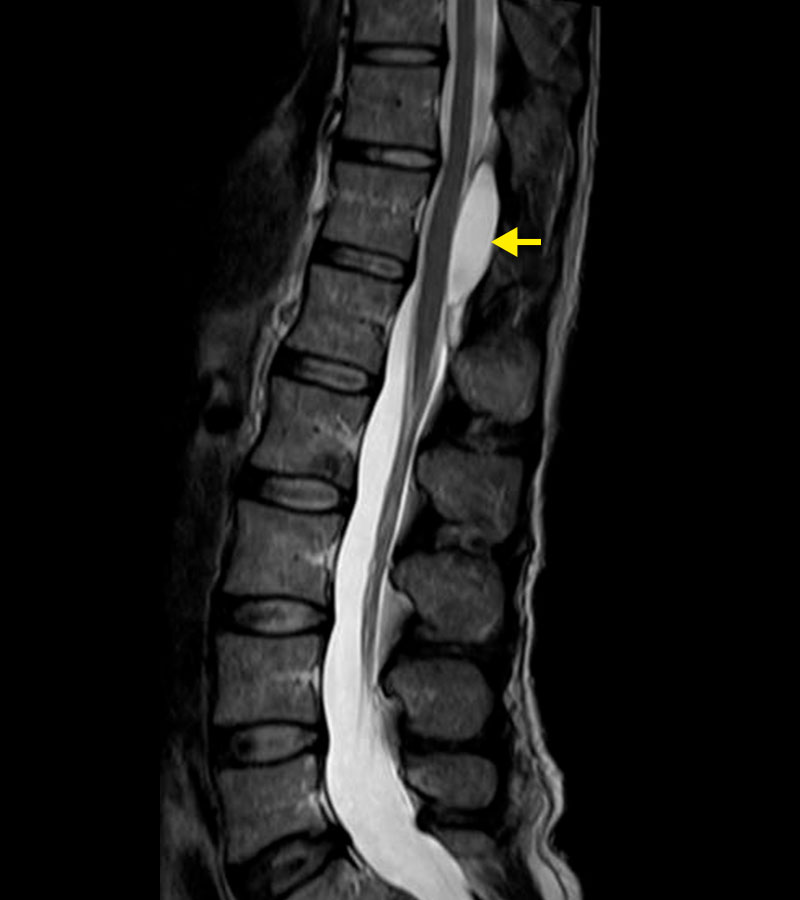 X-ray of the thoracic spine with spinal cord compression due to an arachnoid cyst