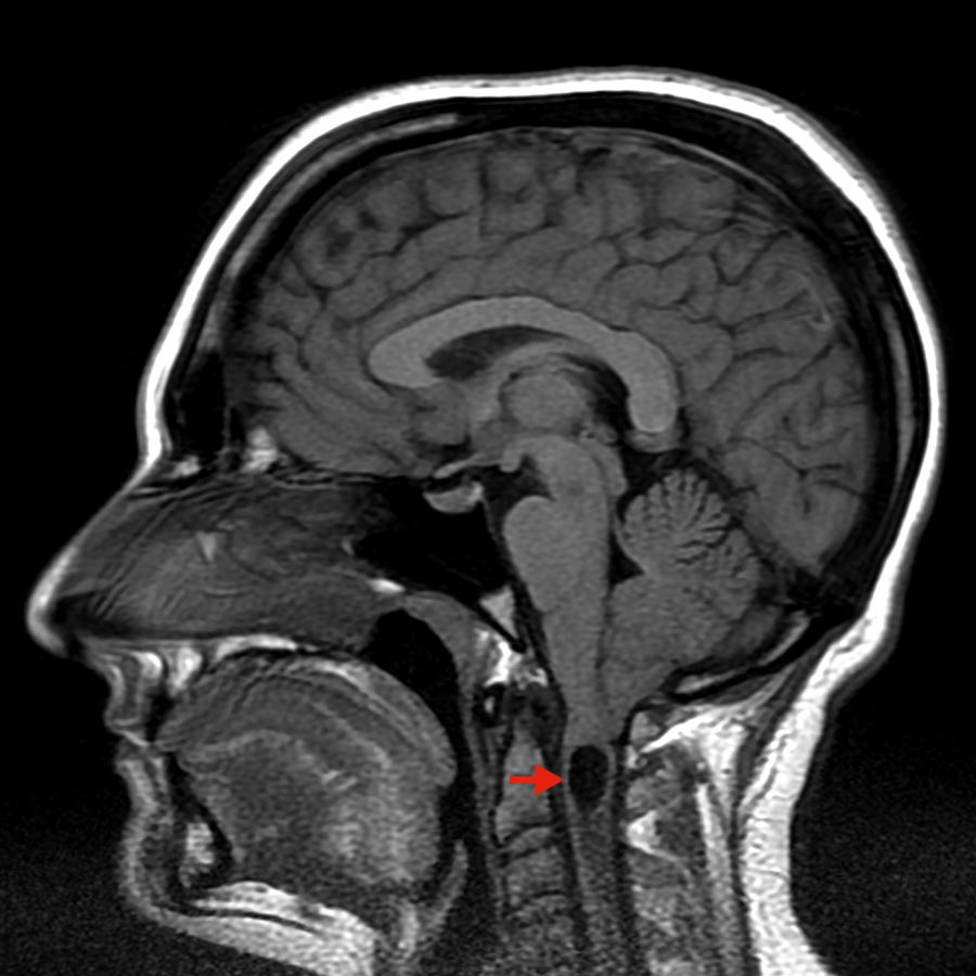 MRI-Bild einer Chiari-Malformation Typ I mit zervikaler Syringomyelie