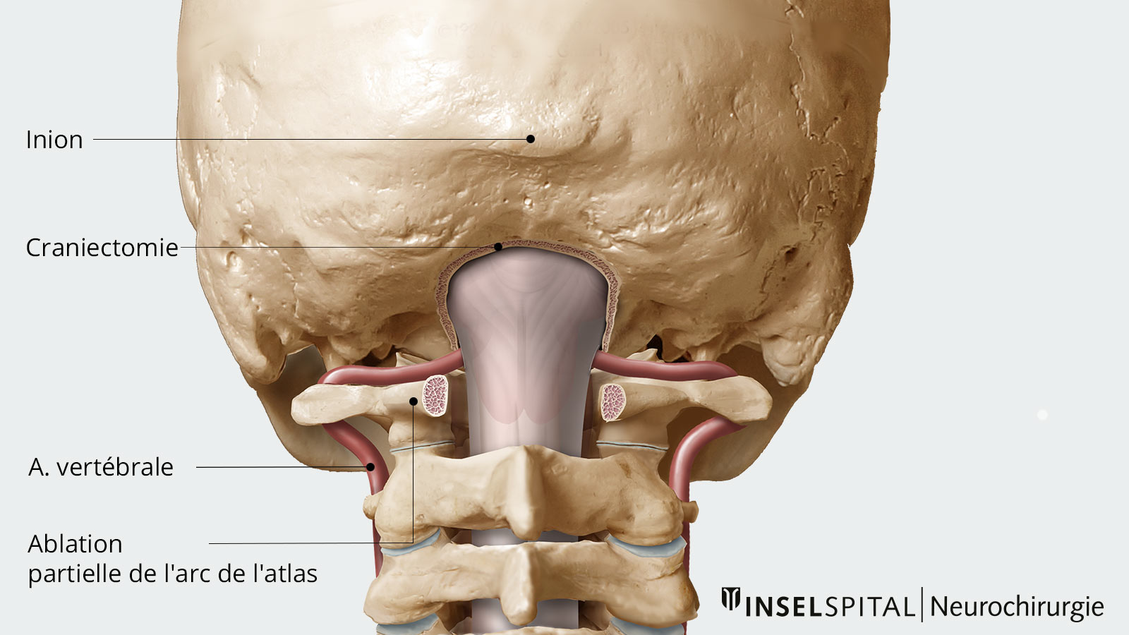 Dessin de la décompression osseuse avec ablation partielle de l'arc atlas