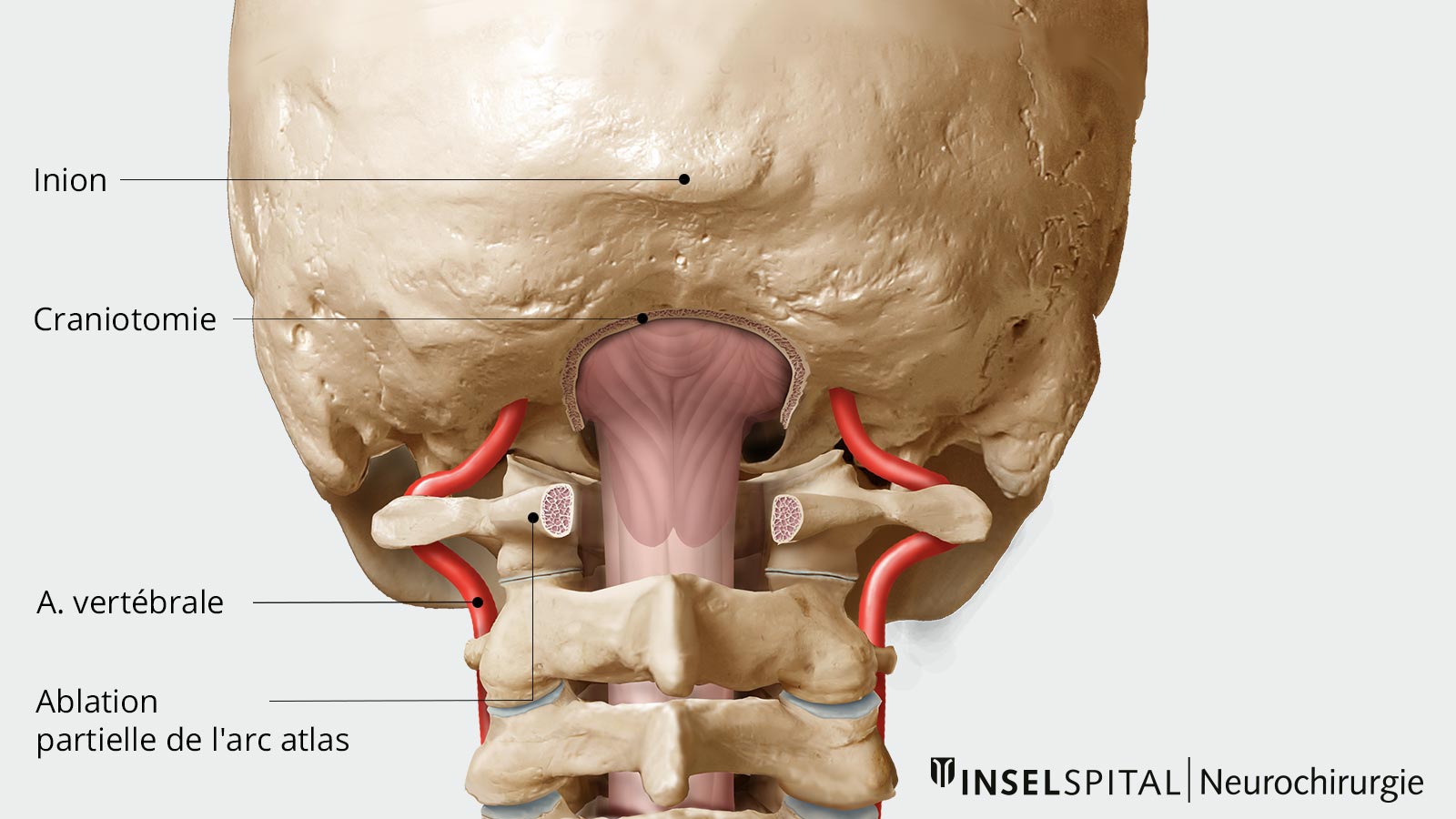 Dessin de la décompression osseuse avec ablation partielle de l'arc atlas