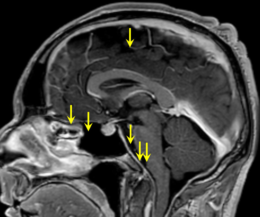 MRI-Aufnahme des Schädels mit absackendem Gehirn