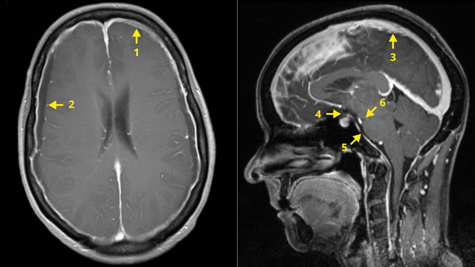 ​Beurteilungsschema des Inselspitals verdeutlicht an 2 MRI-Aufnahmen eines Schädels