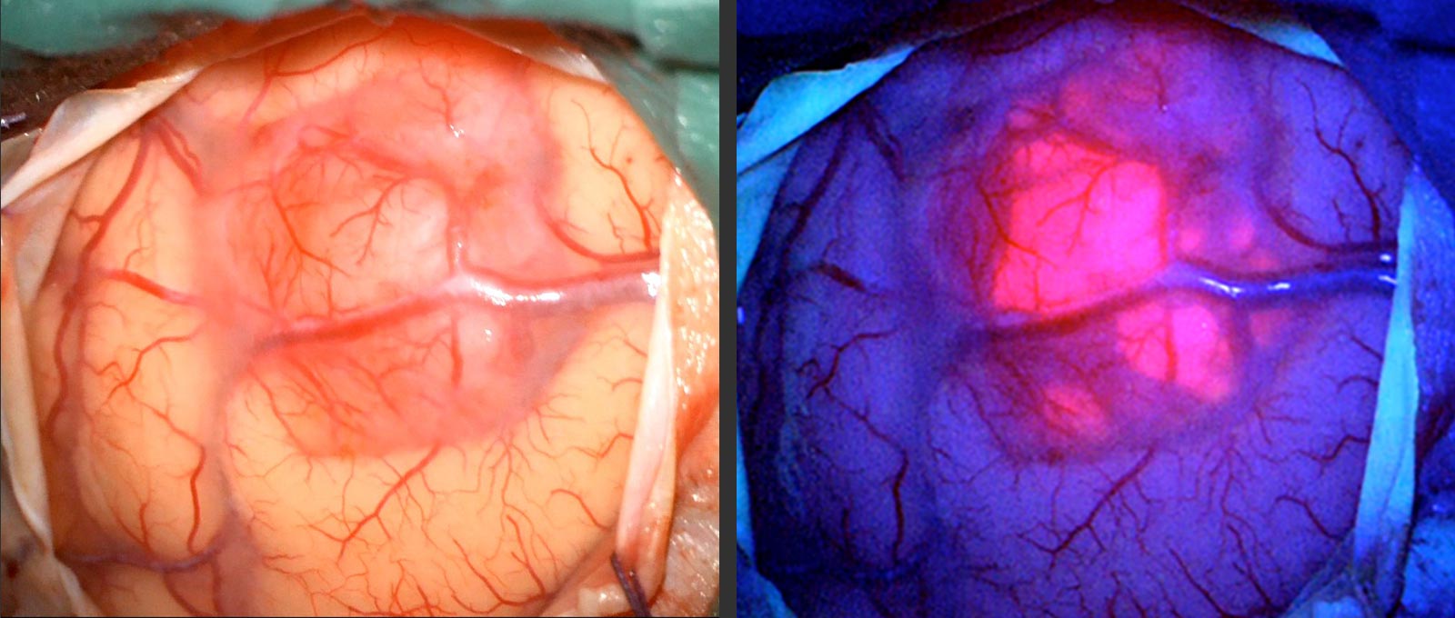 Comparaison de deux photos d'une tumeur. À gauche, sous un éclairage normal et à droite, sous une lumière bleue spéciale, avec du tissu tumoral coloré en rouge et en rose.
