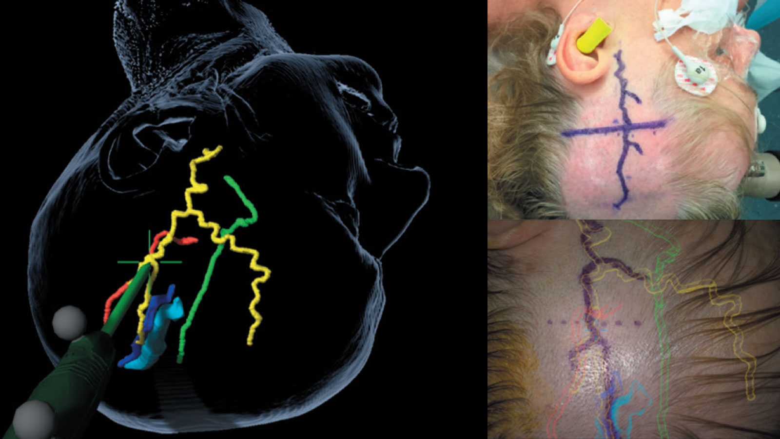 Illustration de la réalité augmentée. À gauche, calcul informatique de l'artère, en haut à droite, artère dessinée sur le cuir chevelu, en bas à droite, données de navigation projetées sur la tête.