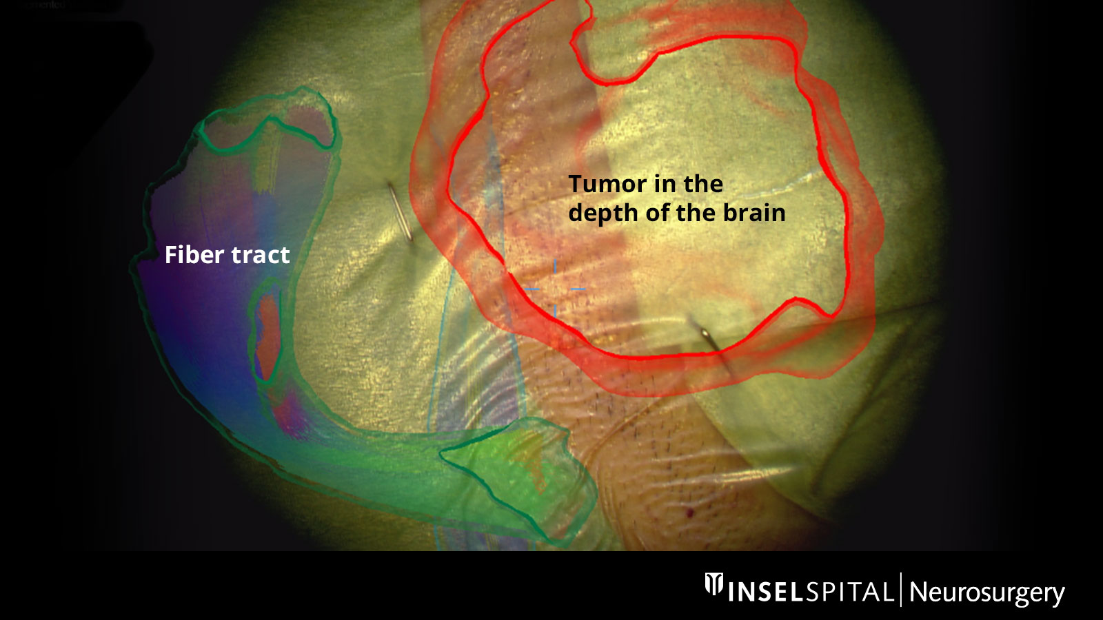 Augmented reality image of the skull. The tumor projected onto the head is circled in red. The fiber tracts are marked in color.