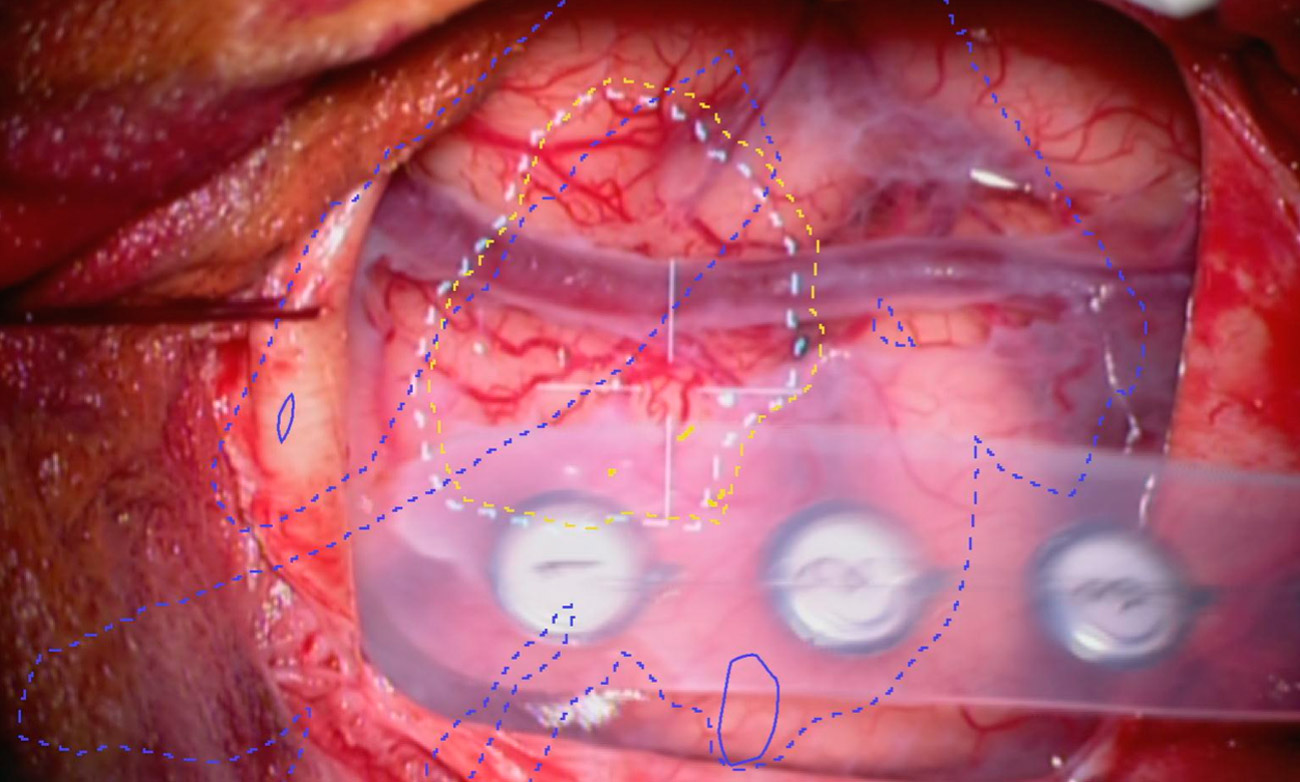 Projection des contours virtuels d'une tumeur et des fibres de la trajectoire importante sur la tête du patient 