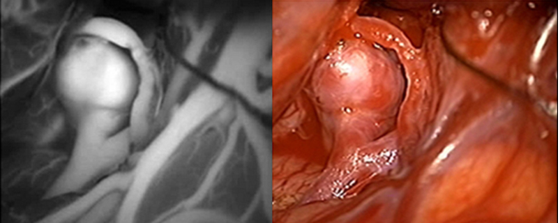 Photos of an aneurysm in normal light and with invisible infrared light