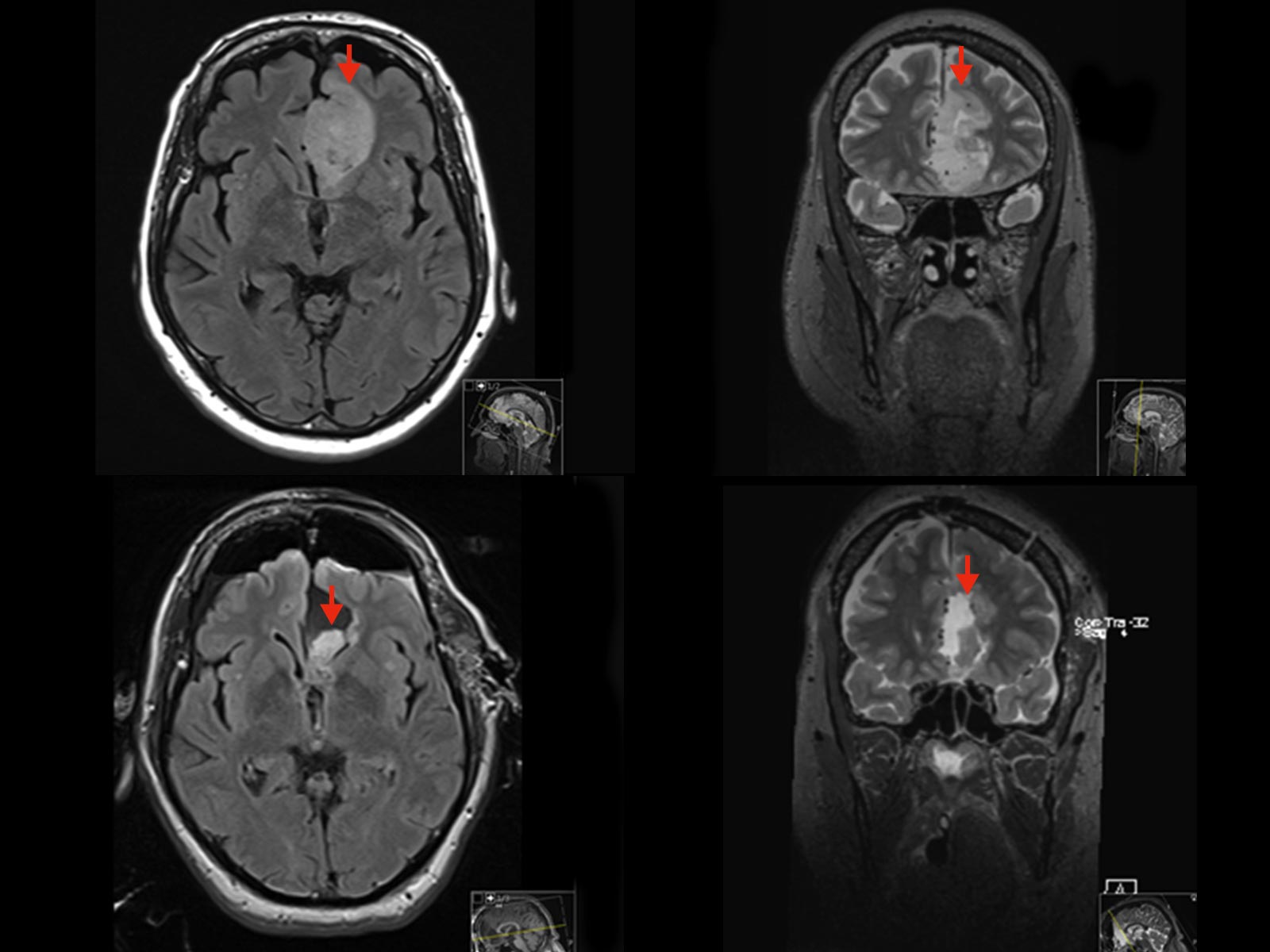 2 MRI-Bilder des Tumors vor der OP, 2 iMRI-Bilder eines Tumorrests