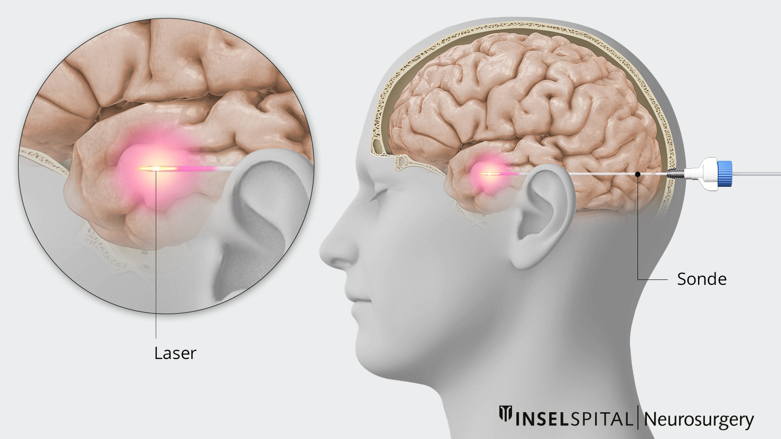 Darstellung einer Laserbehandlung im Gehirn: Eine feine Sonde erhitzt gezielt krankes Gewebe mit Laserlicht.