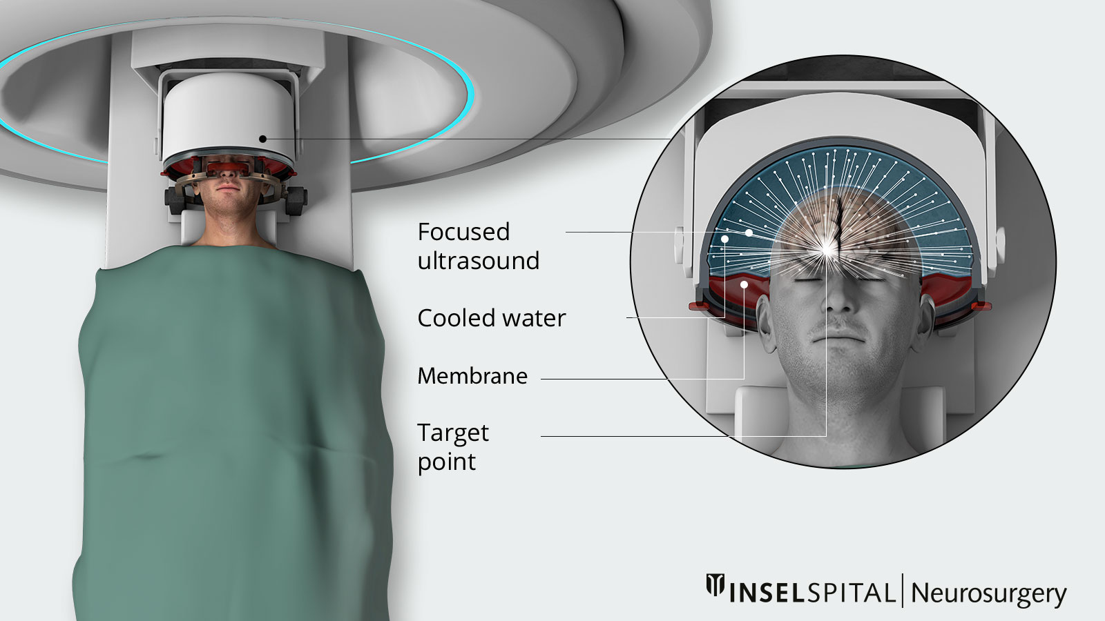 Illustration of an MRgFUS procedure inside an MRI scanner: focused ultrasound waves are precisely directed at a target point in the brain via a cooled helmet.