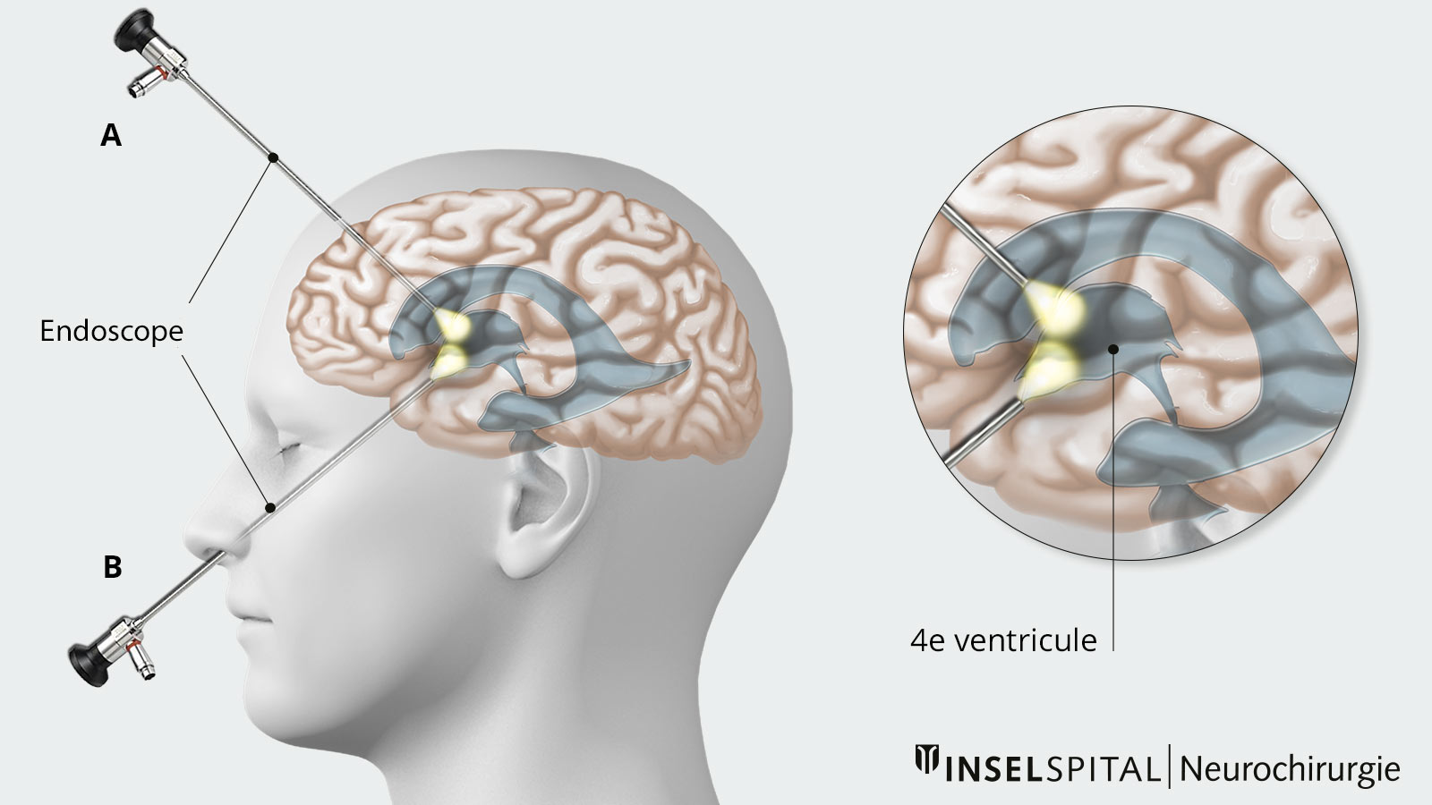 Dessin illustrant l'accès transcrânien au système ventriculaire et l'accès transnasal à la base du crâne.