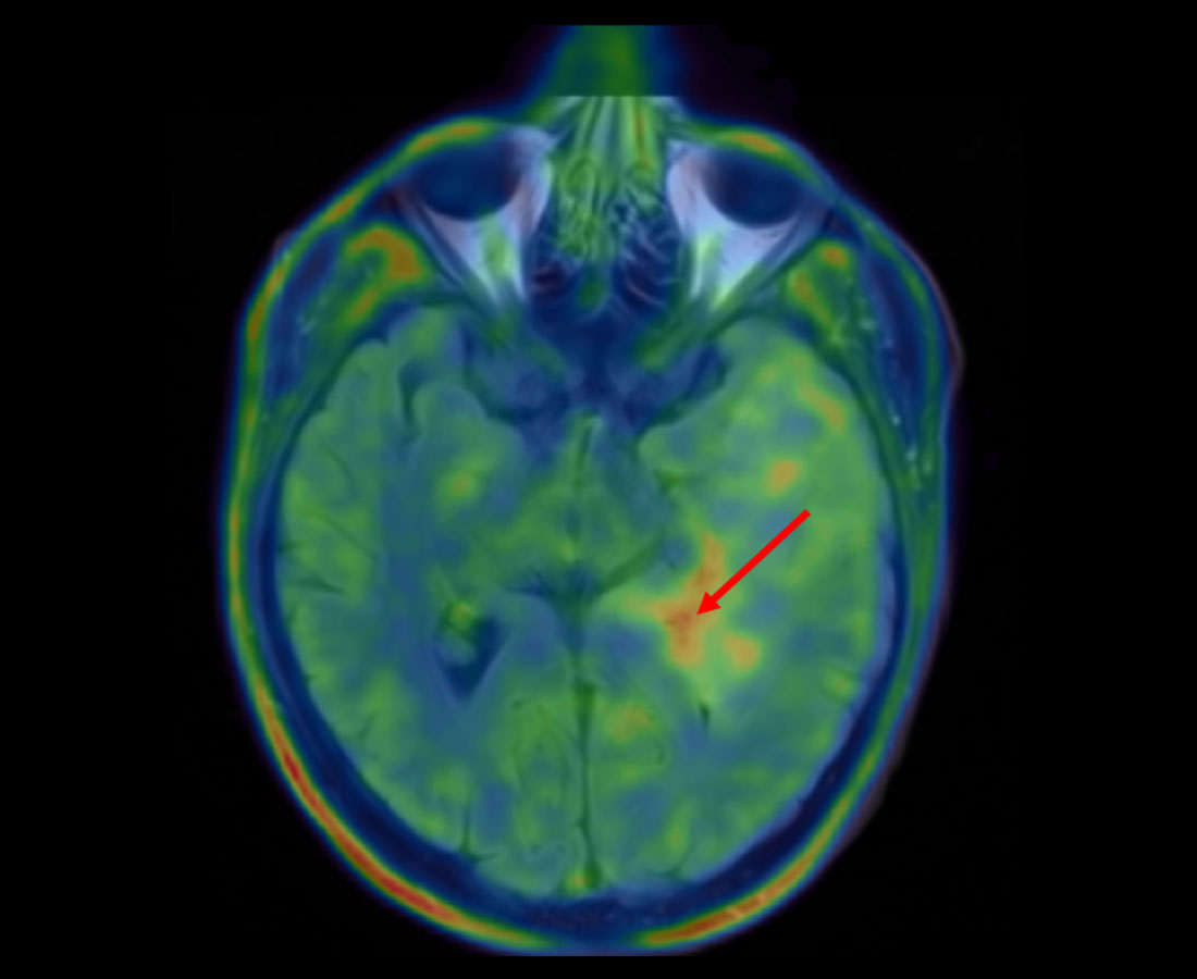La superposition d'images en couleur des données TEP-FET et IRM montre un point chaud dans la tumeur. La zone est marquée d'une flèche rouge. 