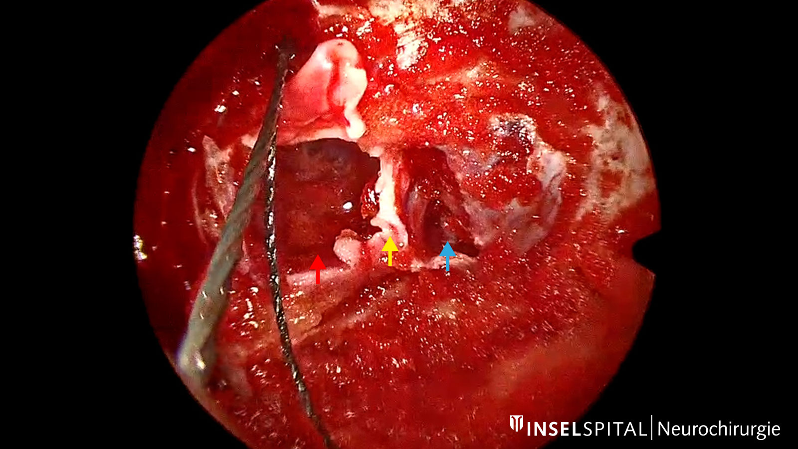 View through the endoscope showing the cavernous sinus