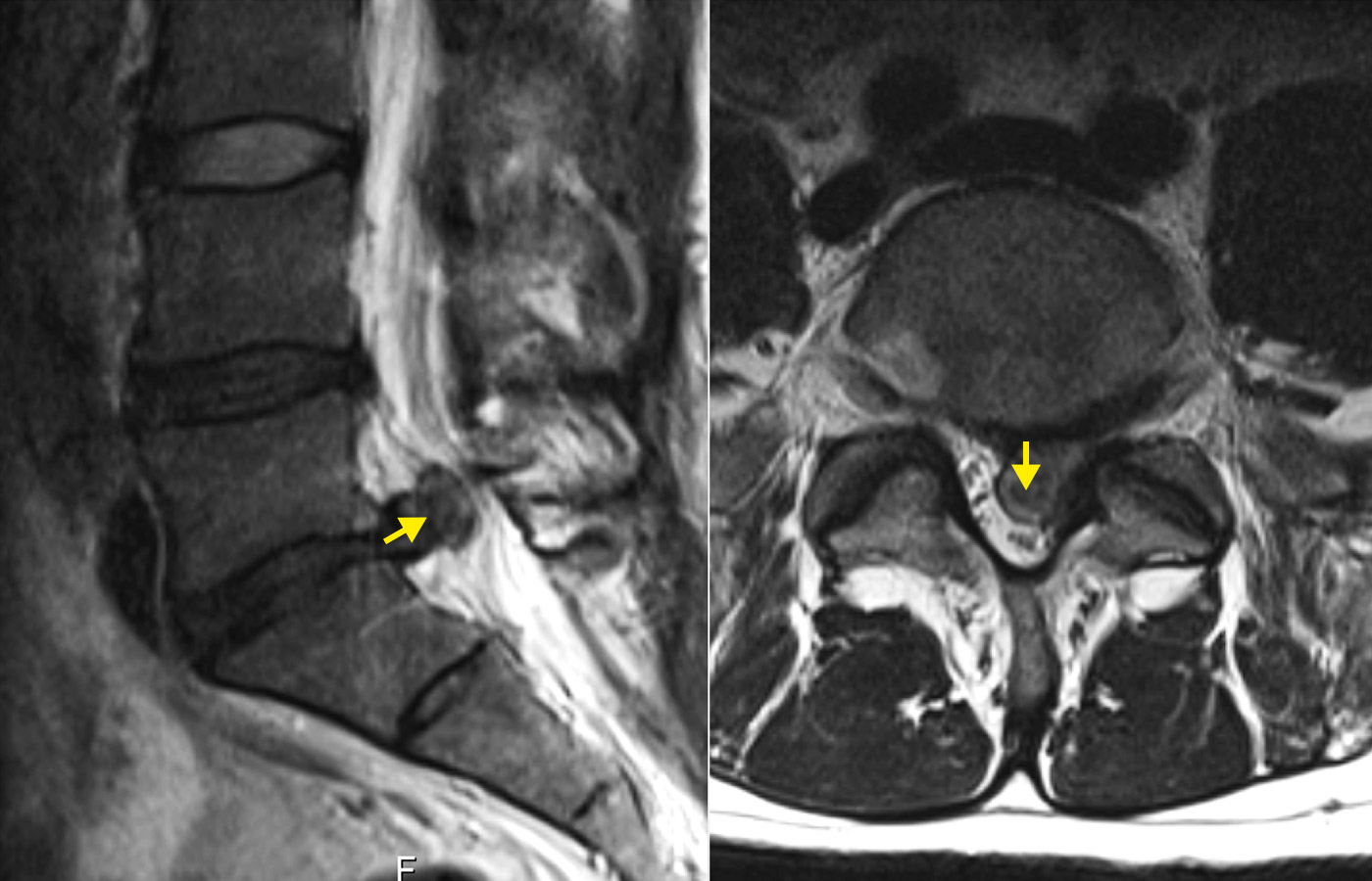 ​2 MRI images of a lumbar disc herniation with visible sequestration