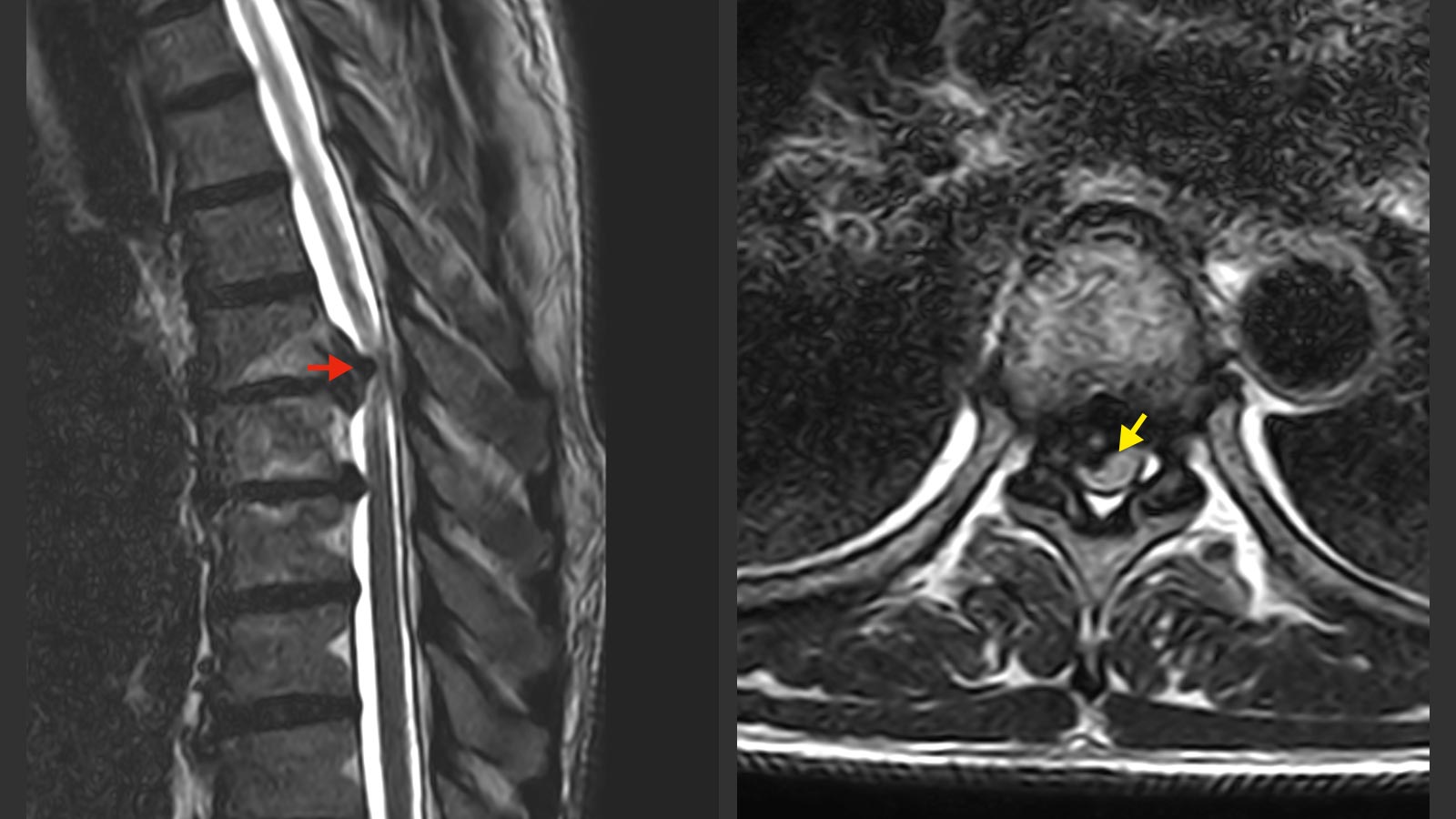 ​2 MRI images showing thoracic disc herniation and compressed spinal cord