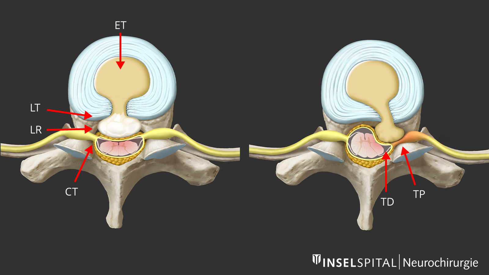 ​2 drawings of the 6 possible access routes for hard, calcified and soft herniated discs in the thoracic spine.