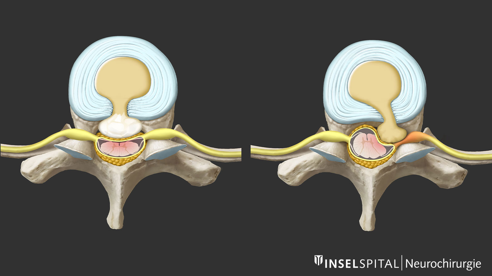 2 dessins de hernie discale thoracique : dure et calcifiée à gauche, molle à droite.