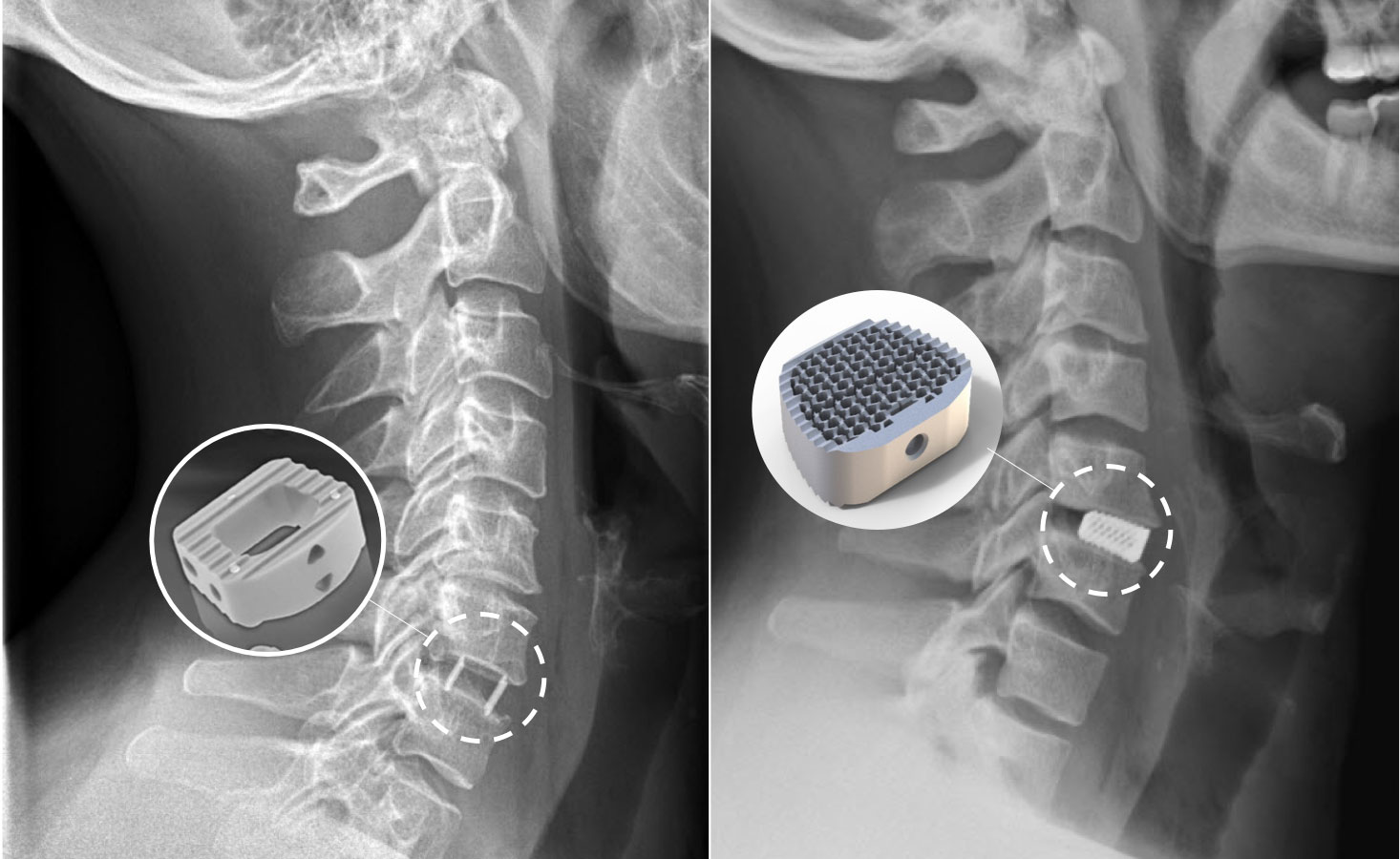 ​Images IRM avec des cages plastiques ou titanes