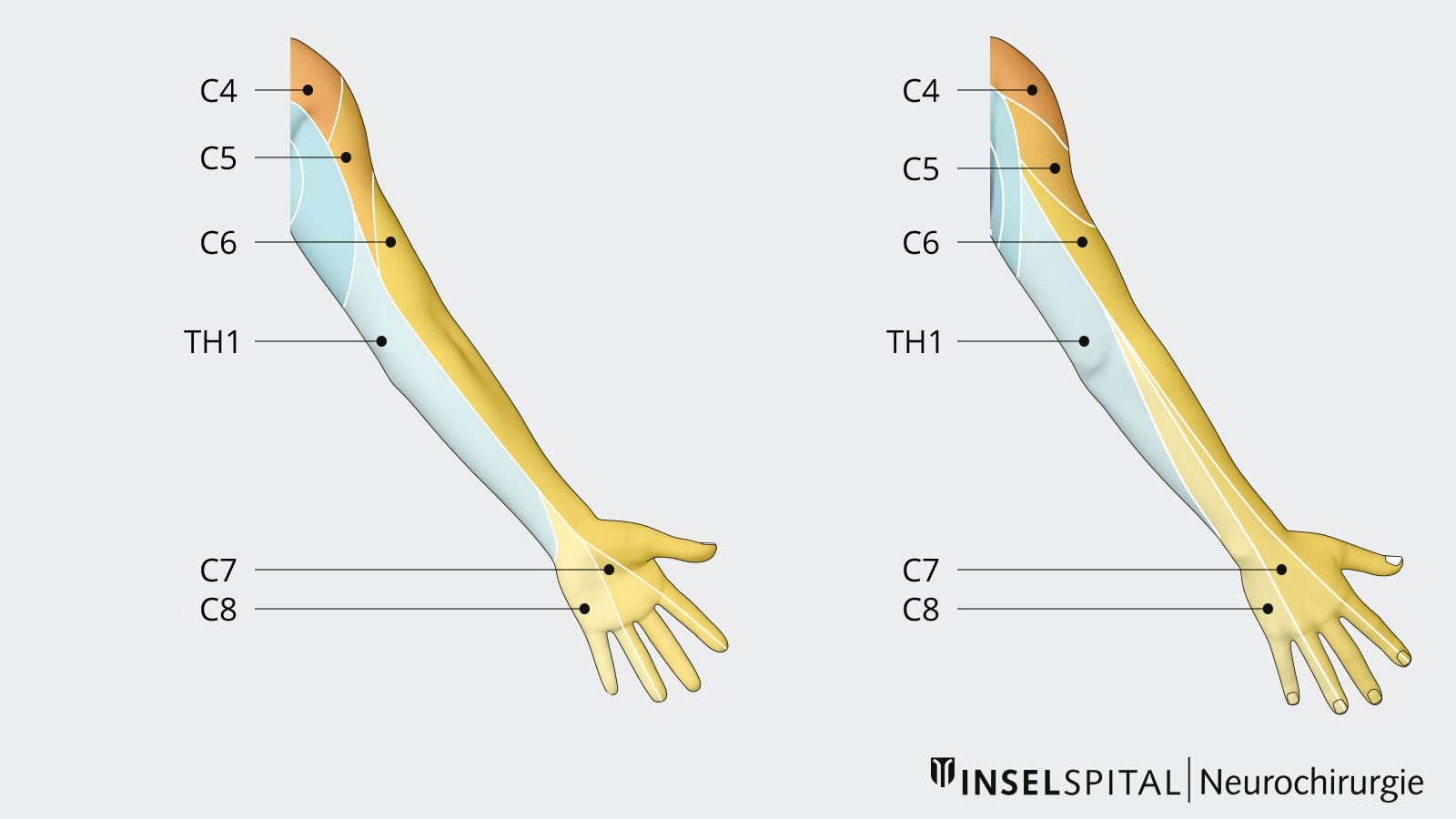 Drawing of the dermatomes on the hand and arm