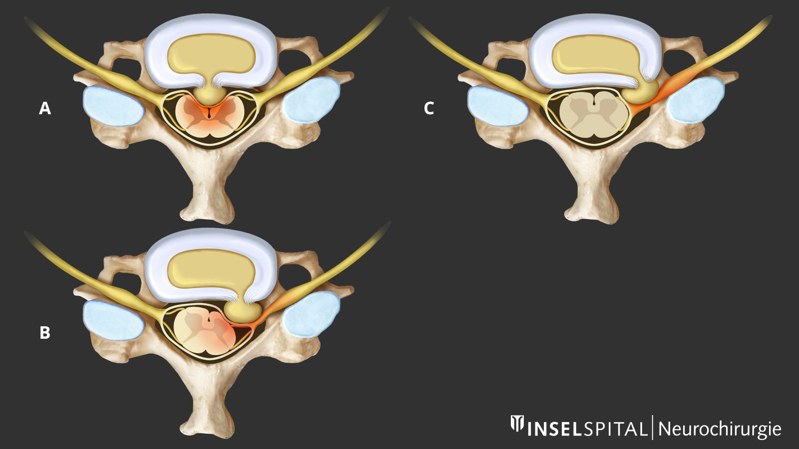 Drawing of 3 differently positioned disc hernias with correspondingly different compression