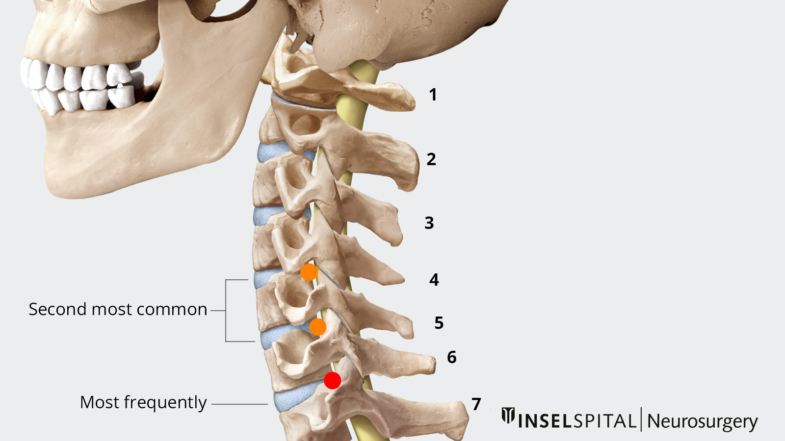 ​Drawing of the cervical spine marking the cervical vertebrae where prolapses most commonly occur
