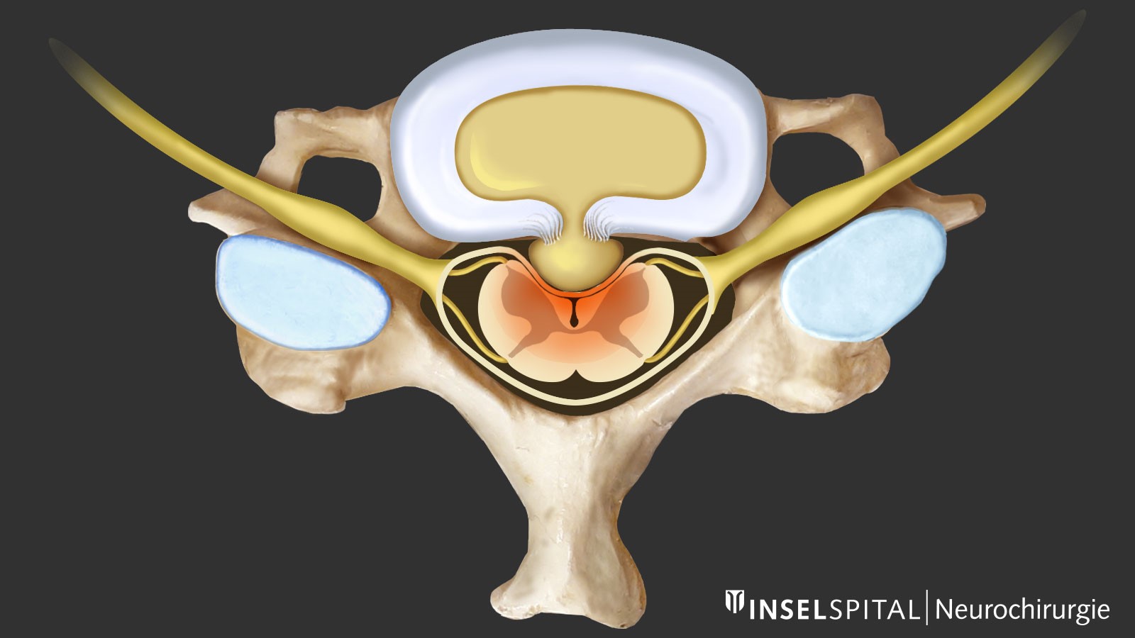 Zeichnung einer Rückenmarkskompression nach Bandscheibenvorfall