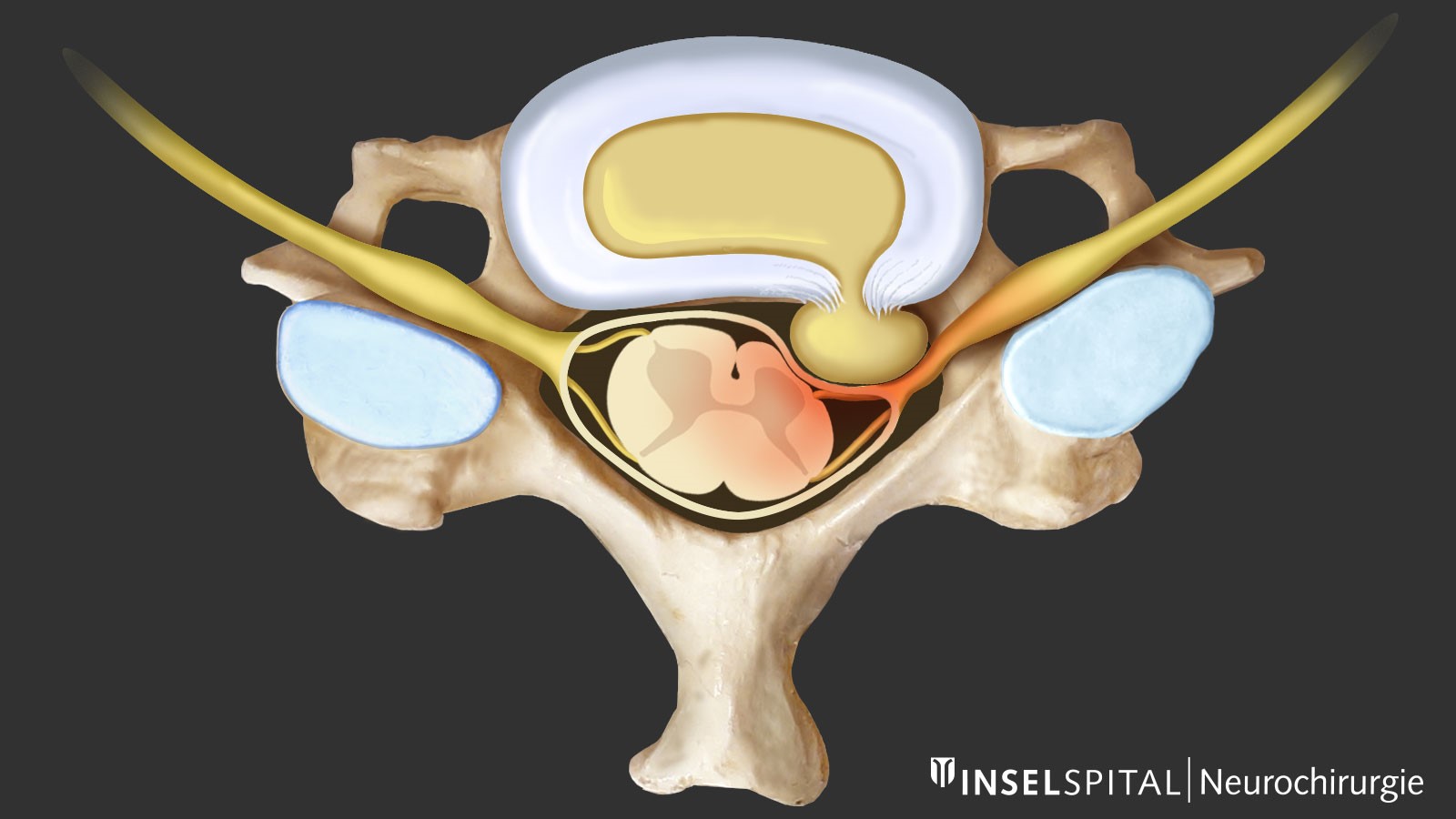 ​Drawing of herniated cervical spine