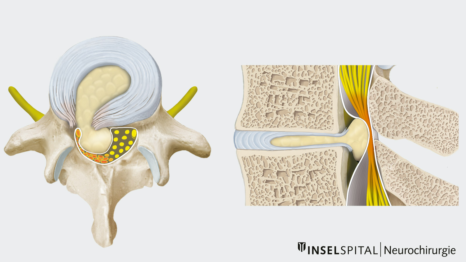 Bandscheibenvorfall Neurochirurgie Inselspital Bern