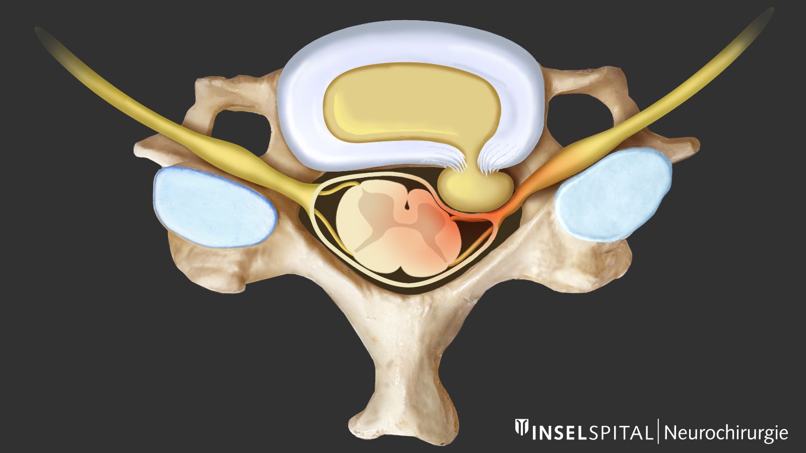 Herniated Disc – Petersen Neurospine