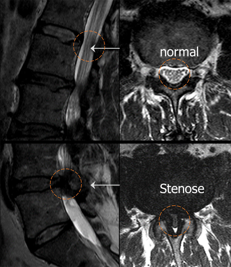 ​MRI images of a spinal stenosis (lateral and cross-sectional)
