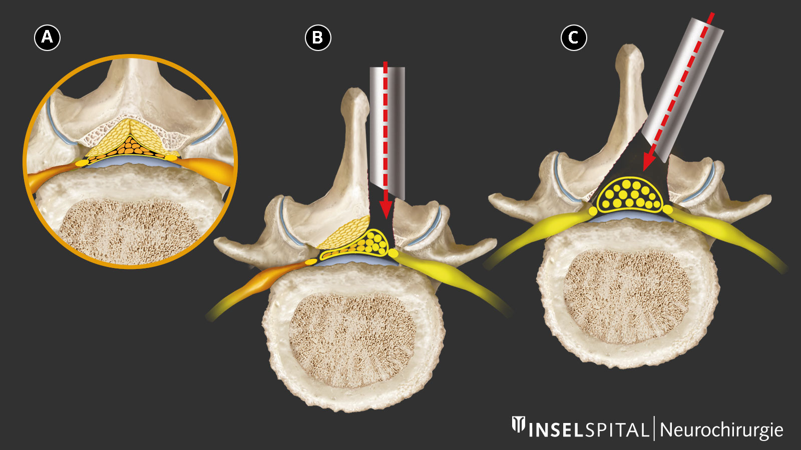 Die tubuläre Mikrochirurgie einer Spinalkanalstenose ist hier in 3 Teilzeichnungen dargestellt.