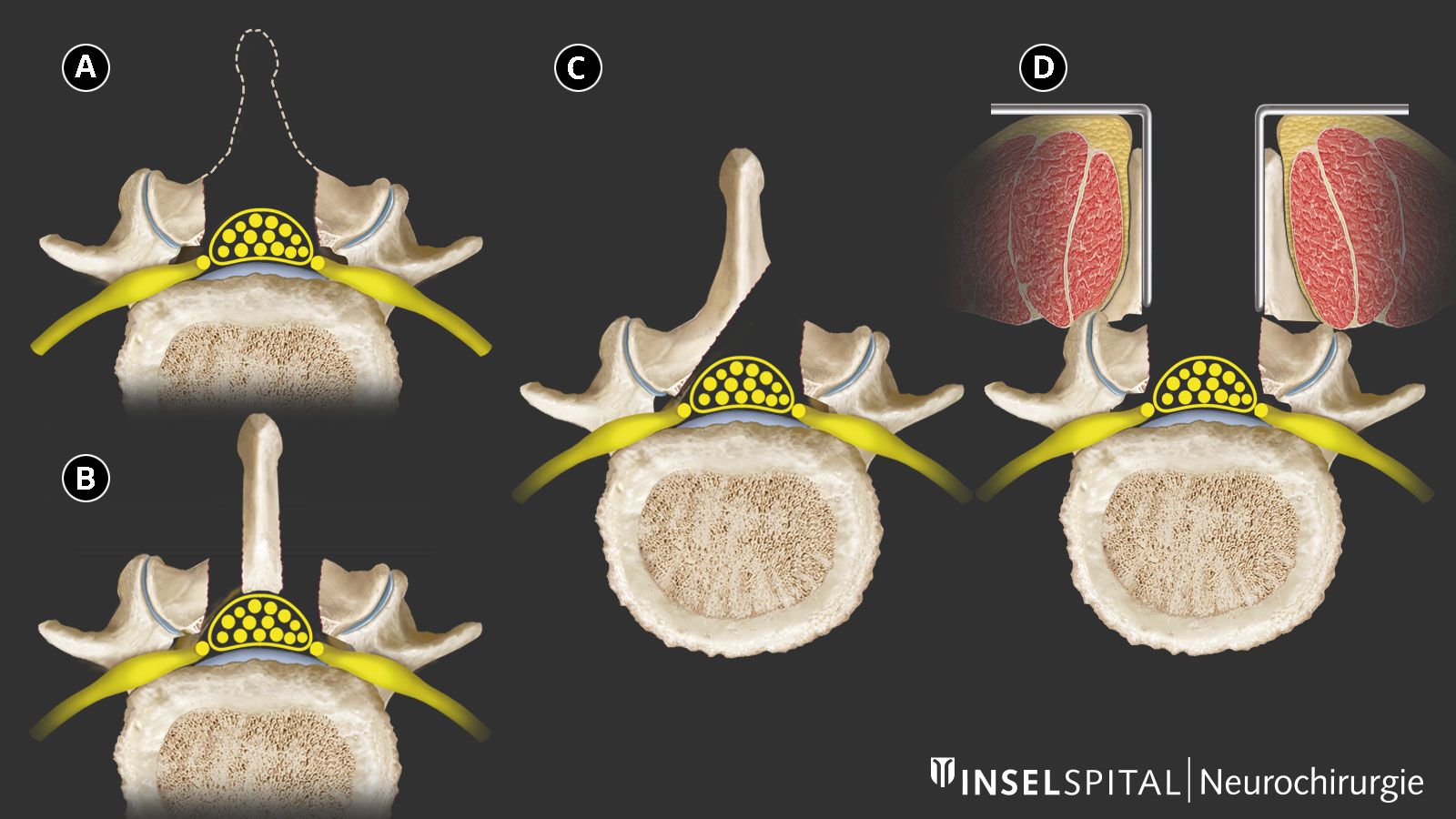 Overview drawing of possible surgical techniques and approaches in lumbar spinal stenosis.
