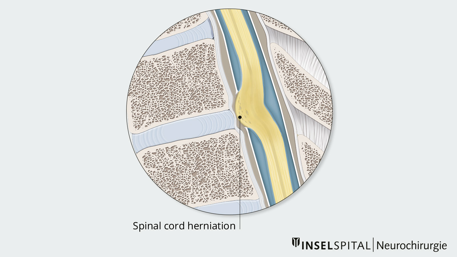 Drawing of spinal cord herniation in lateral view