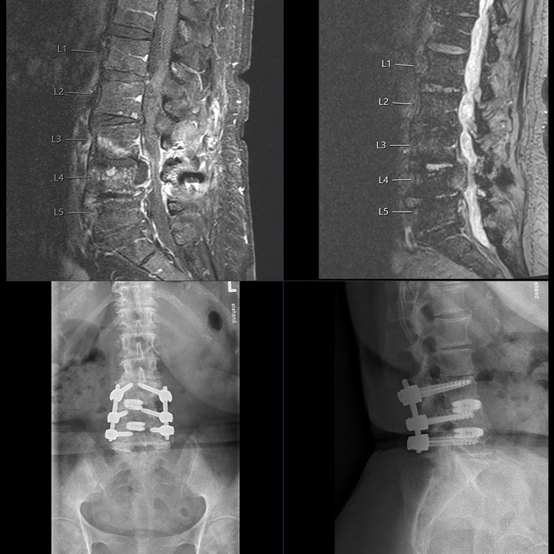 MRI and X-ray images of spondylodiscitis and spinal fusion (spondylodesis)