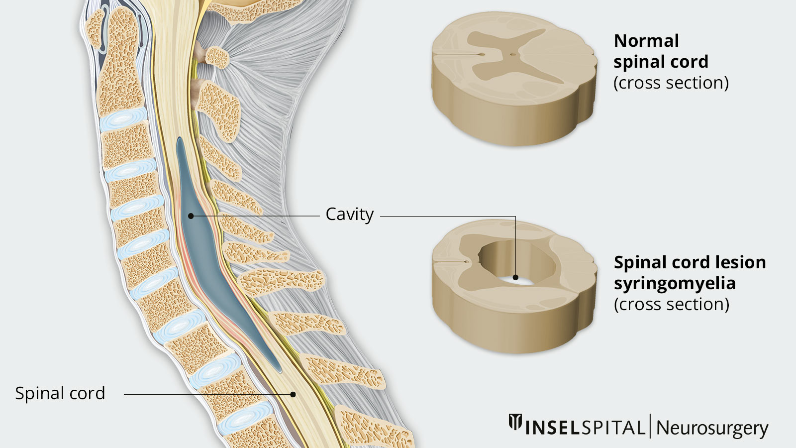 ​Drawing of spinal cord showing cavity displacing spinal cord. Detailed drawings of normal spinal cord and spinal cord with syringomyelia in cross section. 