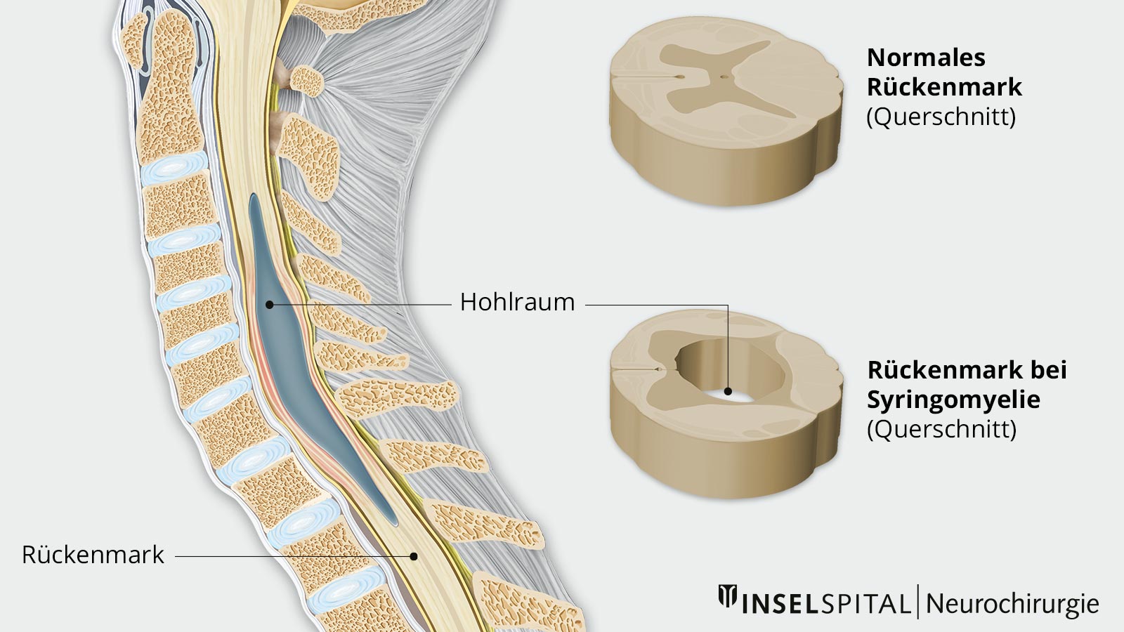 Zeichnung des Rückenmarks mit Hohlraum, der das Rückenmark verdrängt. Detailzeichnungen von normalen Rückenmark und Rückenmark bei Syringomyelia im Querschnitt.
