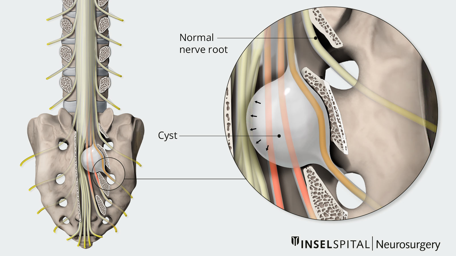 Tarlov Cyst Neurosurgery Inselspital Bern