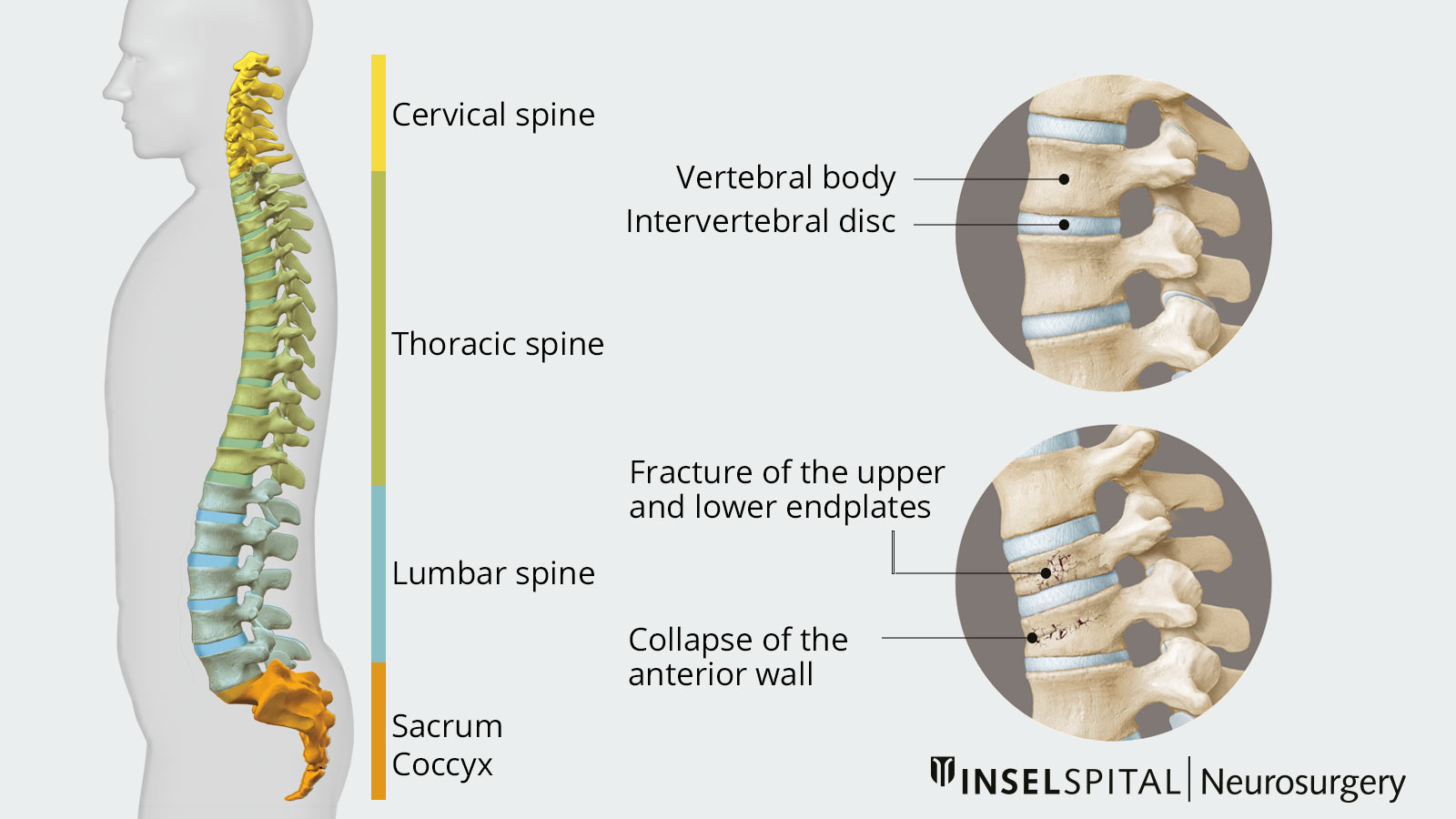 Drawing of the complete spine in side view. Different vertebrae are marked in different colors. In detail view you can see vertebral body and intervertebral disc as well as 2 types of vertebral fracture.