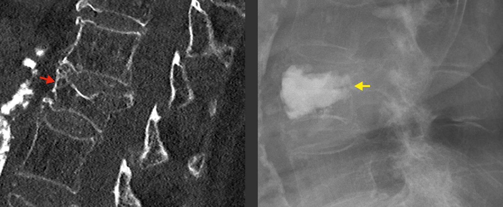 2 images de scanner. Fracture de la vertèbre lombaire à gauche, à droite postopératoire avec comblement par du ciment