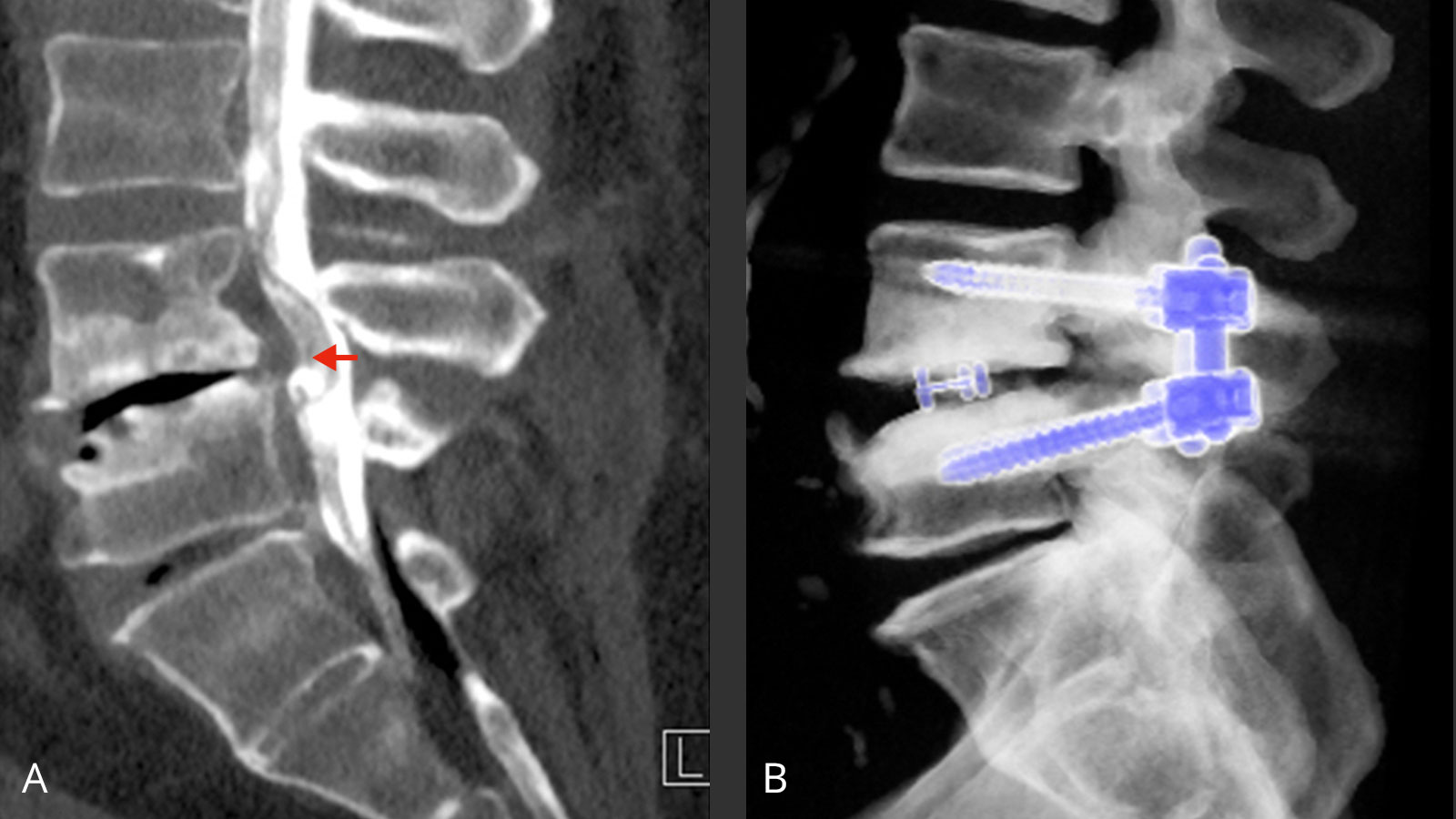 Two images from a CT myelography: left before surgery, right after surgery.