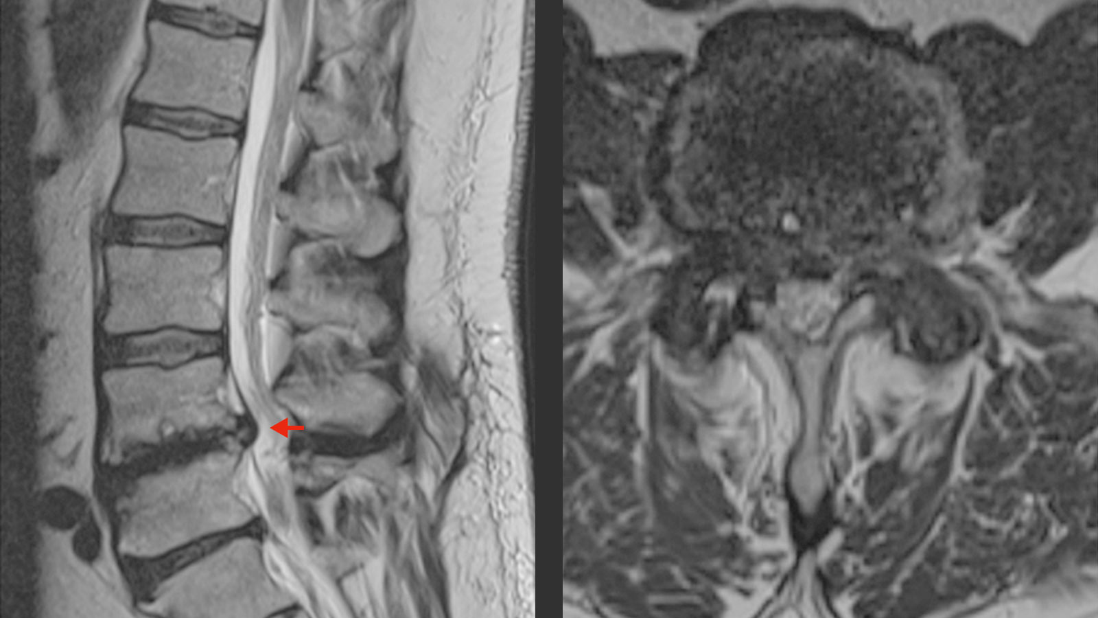 Image IRM du rachis lombaire en position couchée avec spondylolisthésis mineur