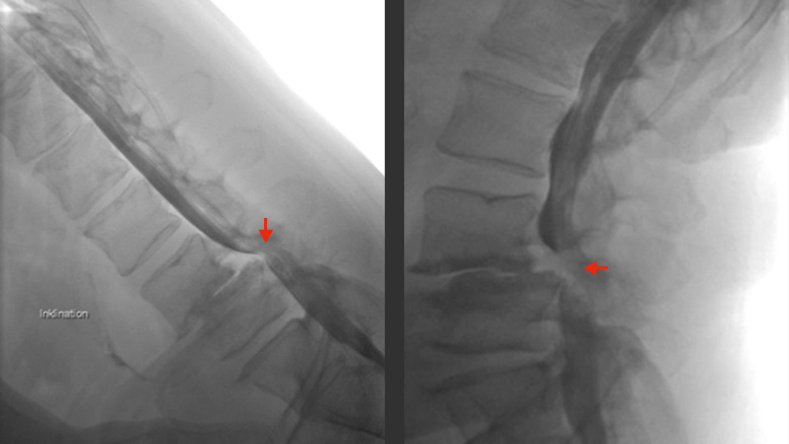 X-ray myelography image of spondylolisthesis