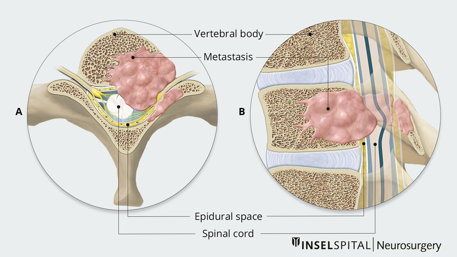 Cross-sectional drawing of a vertebral body with clearly visible metastasis and spinal cord compression