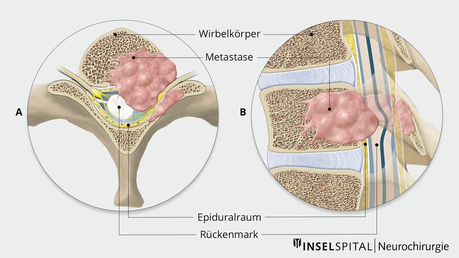 ​Querschnittzeichnung Wirbelkörper​ mit deutlich sichtbarer Metastase und Rückenmarkskompression