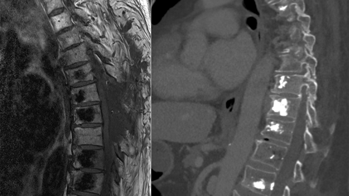 2 X-ray images in comparison. Left before vertebroplasty, right after. Bone cement brightly visible.