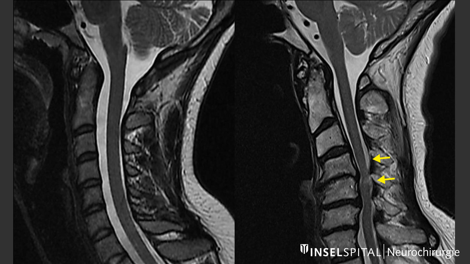 2 MRI images: Normally wide spinal canal on the left, visible narrowing on the right