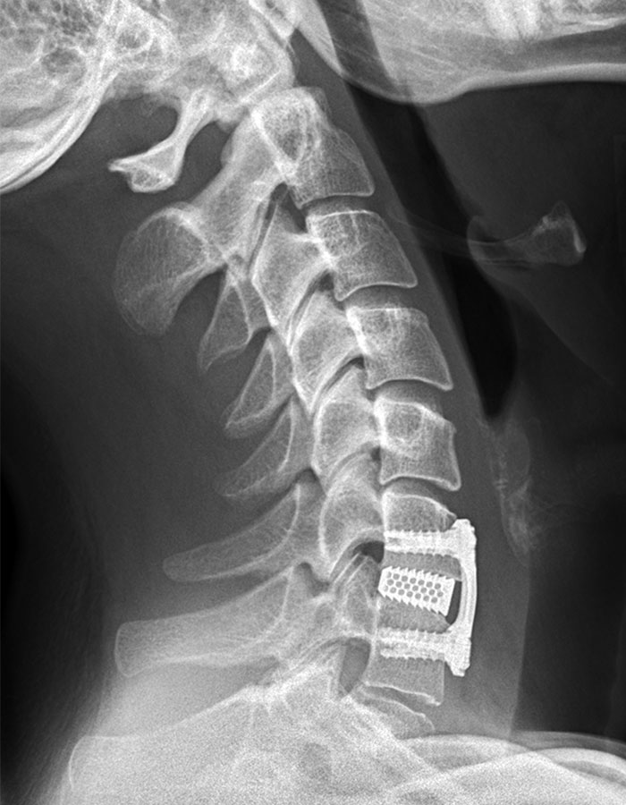 ​Röntgenbild nach Operation mit Cage-Einlage